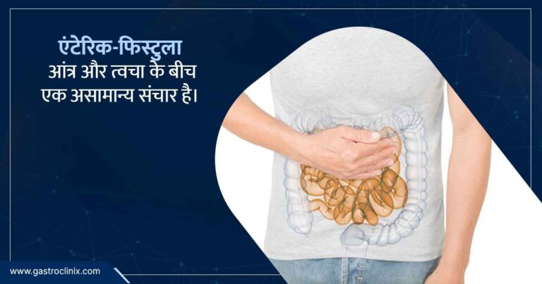 एंटेरिक फिस्टुला के स्पेशियालिस्ट