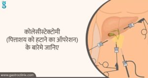 पित्ताशय की थैली हटाने का इलाज