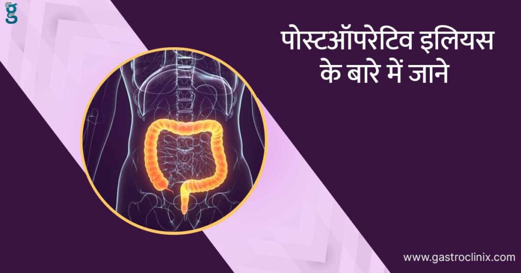 पोस्टऑपरेटिव इलियस के टॉप डॉक्टर