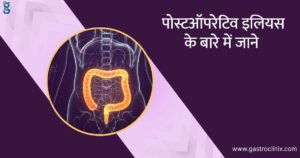 पोस्टऑपरेटिव इलियस के टॉप डॉक्टर