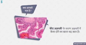 बैरेट्स अन्ननली का इलाज