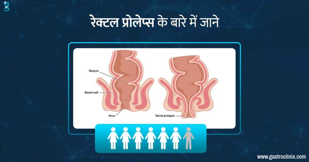 वयस्कों में रेक्टल प्रोलैप्स के श्रेष्ठ डॉक्टर