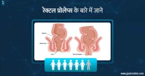 वयस्कों में रेक्टल प्रोलैप्स के श्रेष्ठ डॉक्टर