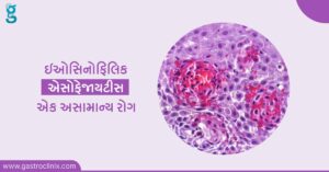ઇઓસિનોફિલિક એસોફેજાયટીસ ની સારવાર