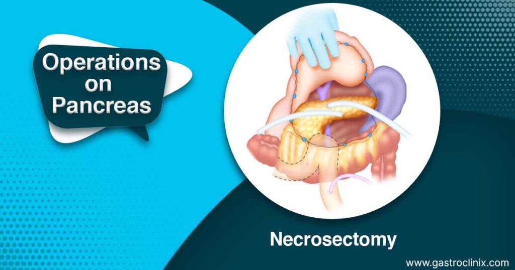 14. Necrosectomy blog