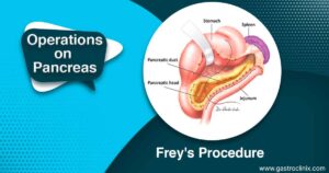 15. Freys procedure blog