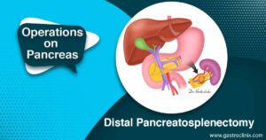 Surgery (Pancreas) 1 16. Distal pancreatosplenectomy blog