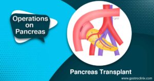 17. Pancreas transplant blog