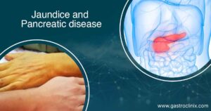 3. Jaundice in pancreatic diseases blog