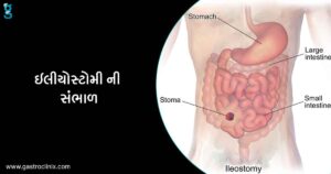 6 ઇલીયોસ્ટોમી blog