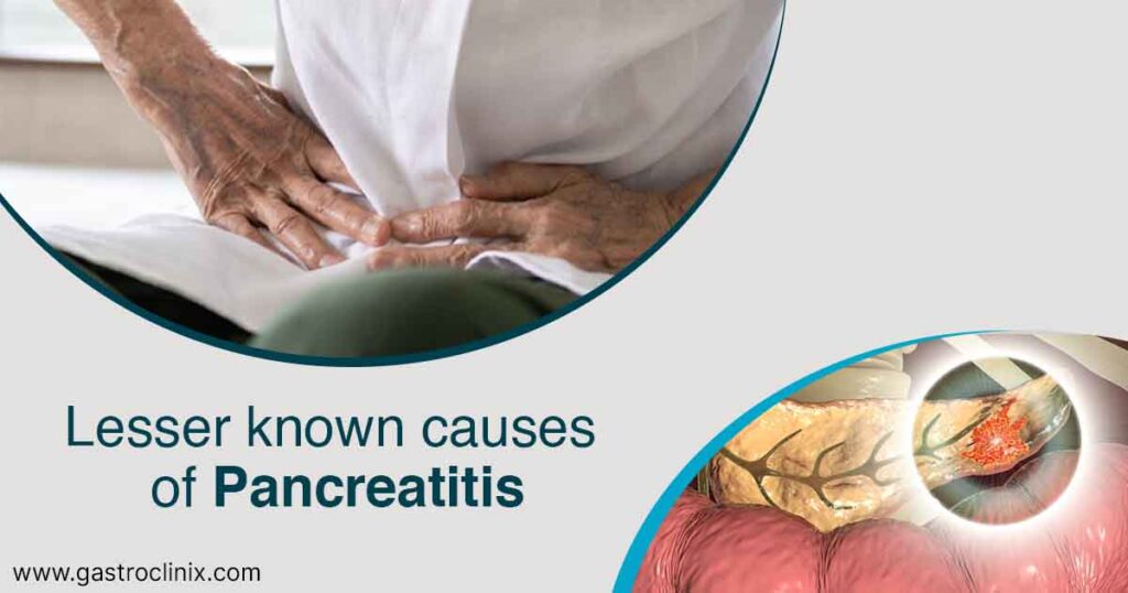 8. Less common causes of pancreatitis blog