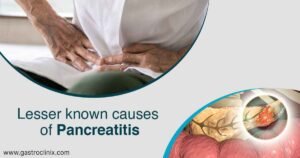 8. Less Common Causes Of Pancreatitis Blog