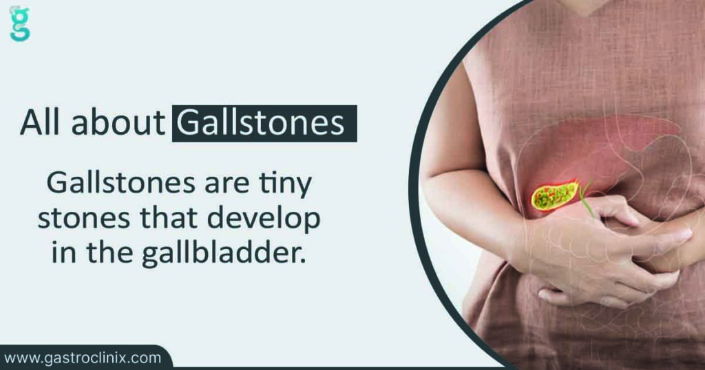 Best Doctor for Gallstone Treatment