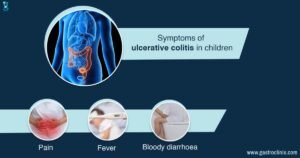 Best Treatment For Ulcerative Colitis In Children
