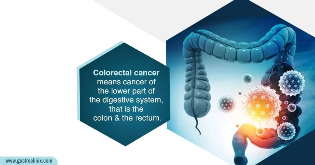 Colorectal Cancer - Irregular pain in your abdomen - This could be a sign of cancer related to the intestines.