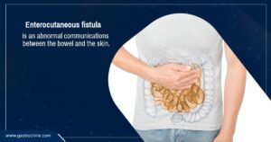 Enteric Fistula