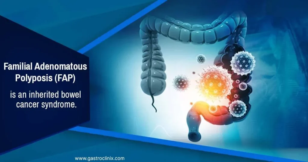 Familial Adenomatous Polyposis - Know your genetic risks