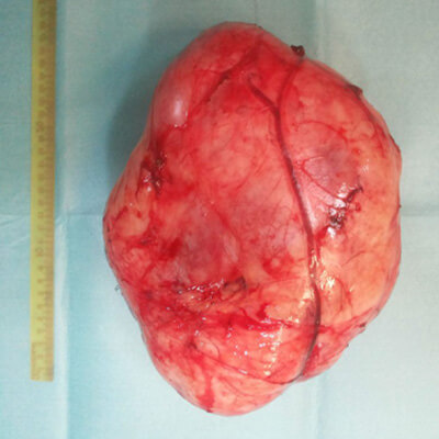 Large Abdominal tumour thumb