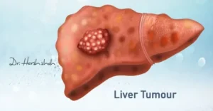 Liver cancer