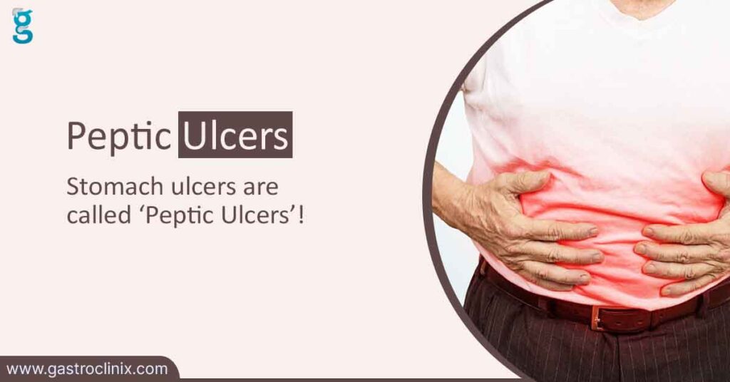 Peptic Ulcers blog