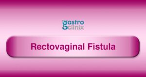 Rectovaginal Fistula