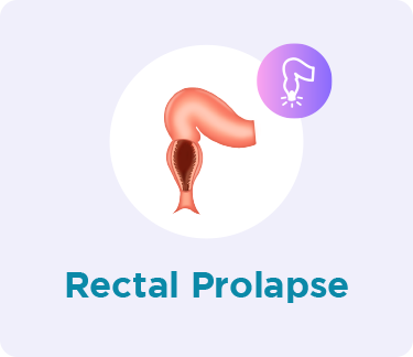 Rectum Rectal Prolapse