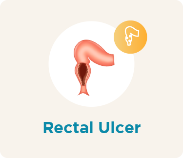 Rectum Rectal Ulcer