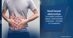Small Bowel Obstruction
