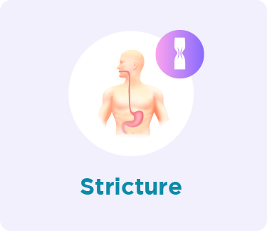 Stricture