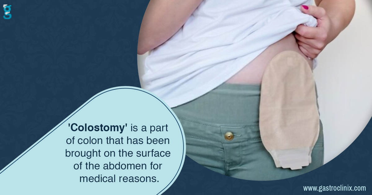 Colostomy Care Dr. Harsh J Shah