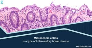 Treatment For Microscopic Colitis