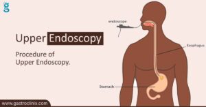 Upper Endoscopy blog