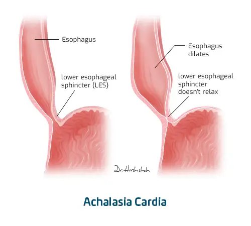 best achalasia cardia treatment in ahmedabad