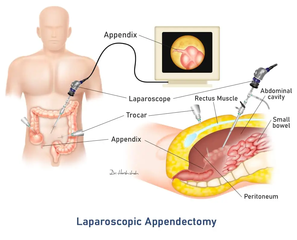 best appendicitis hospital in ahmedabad
