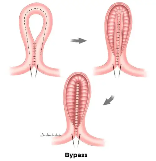 best crohn s disease surgeon in ahmedabad 1