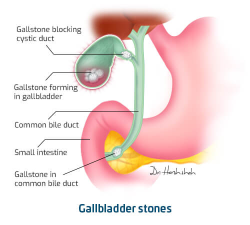 best gallbladder stone treatment in ahmedabad