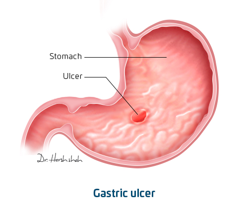best gastric ulcer doctor in ahmedabad