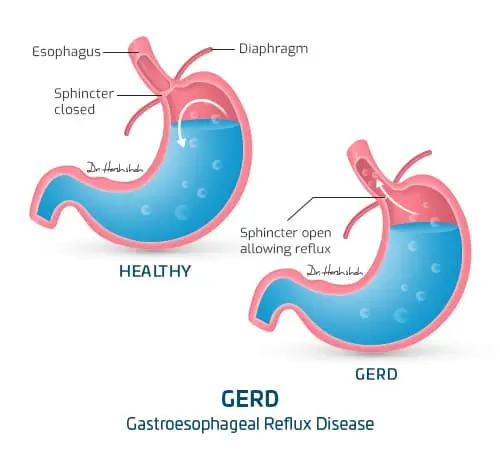 best gerd treatment in ahmedabad