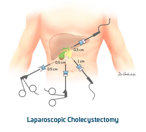 best laparoscopic cholecystectomy doctor in ahmedabad