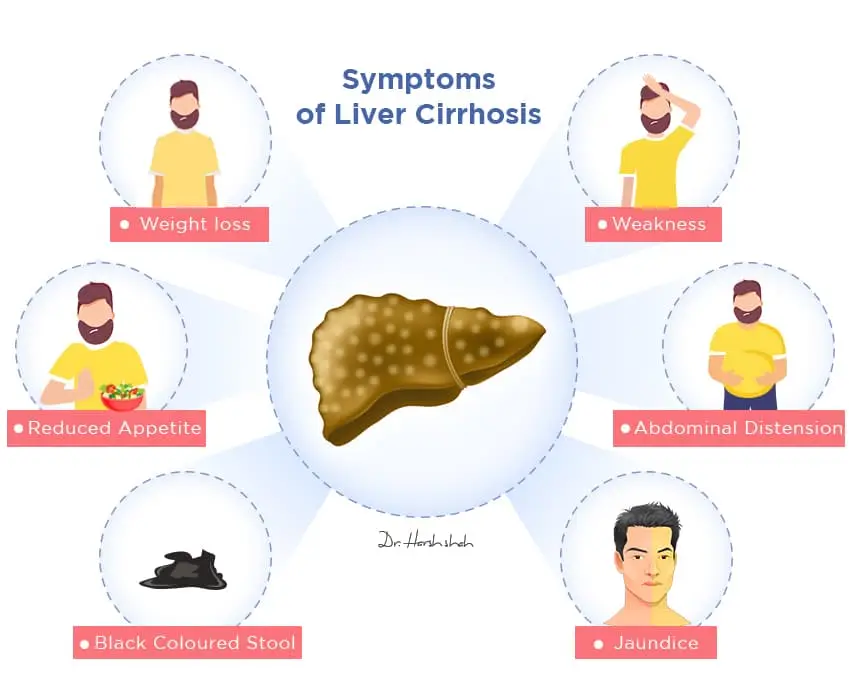 best liver cirrhosis treatment in ahmedabad