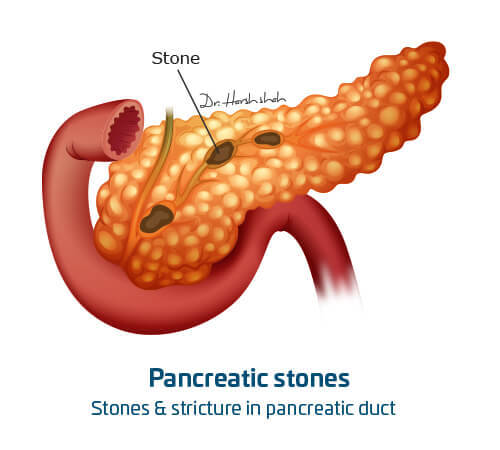 best pancreas stone treatment in india