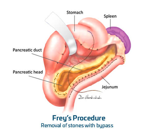 best pancreas stones surgeon in india
