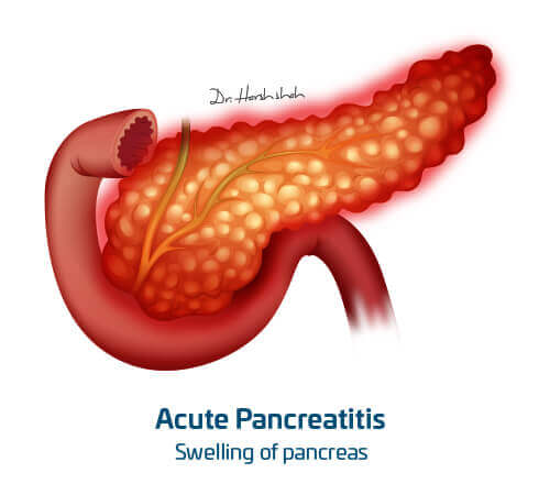 best pancreatitis doctor in ahmedabad
