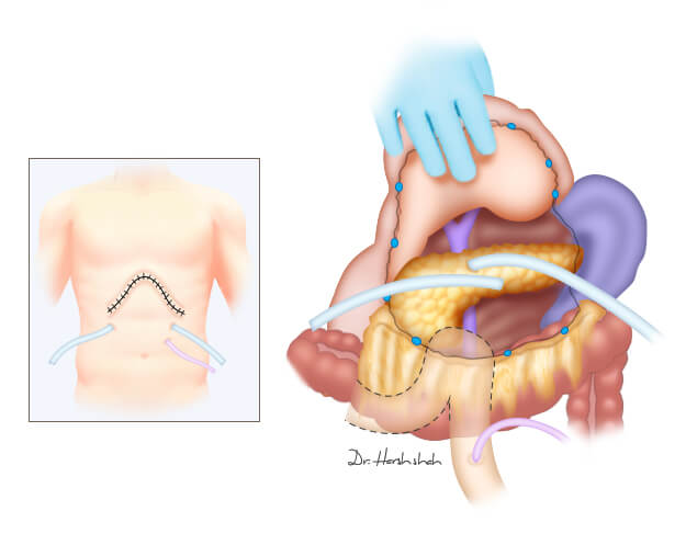 best pancreatitis doctor in india