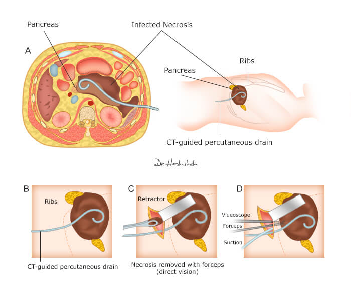best pancreatitis surgeon in india