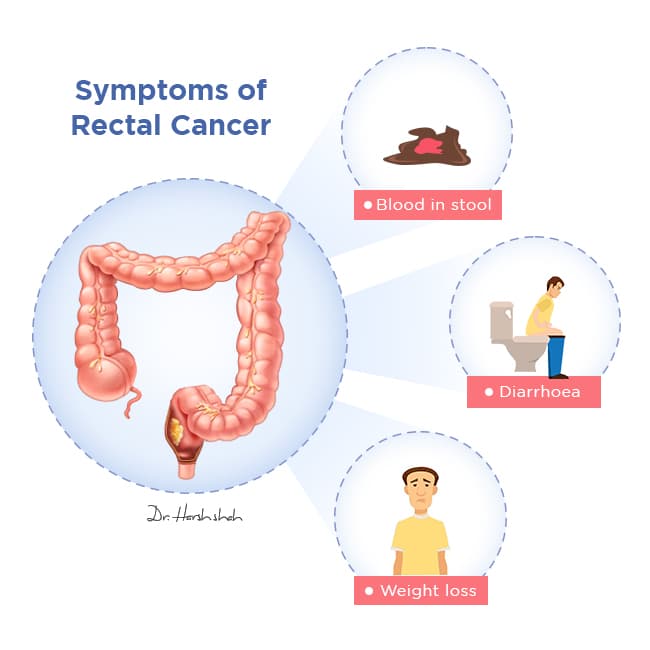 best rectal cancer treatment in ahmedabad
