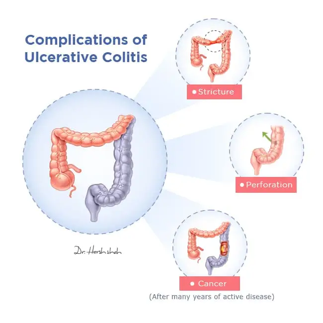 best ulcerative colitis hospital in ahmedabad