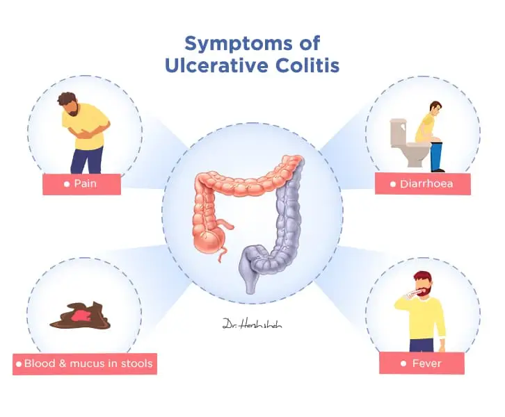 best ulcerative colitis specialist in ahmedabad