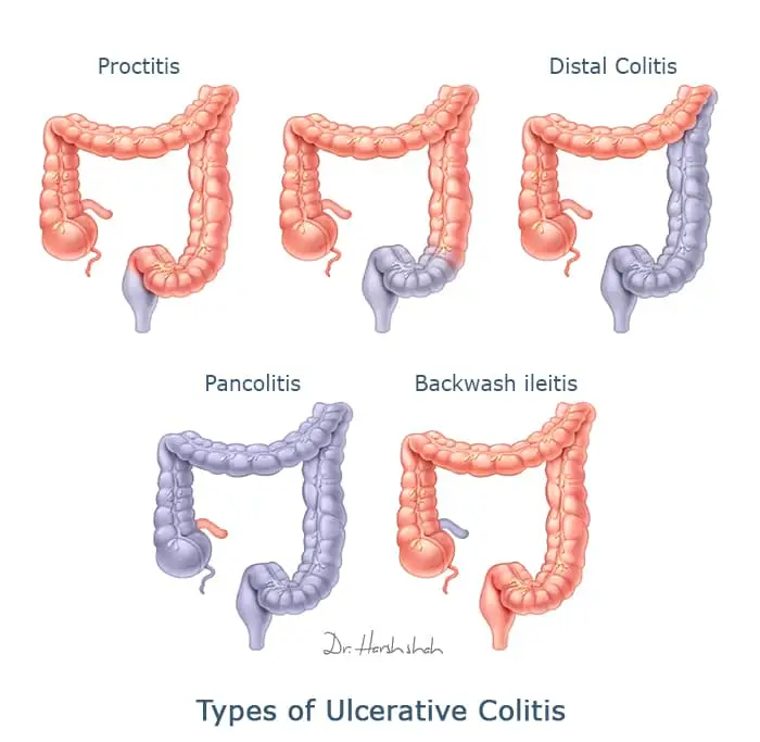 best ulcerative colitis treatment in ahmedabad