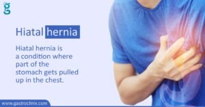 Esophagus Hiatal Hernia Eng